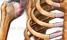 Trật khớp vai và cách điều trị